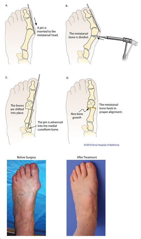 Minimally Invasive Bunion Surgery | Baltimore, MD | International ...