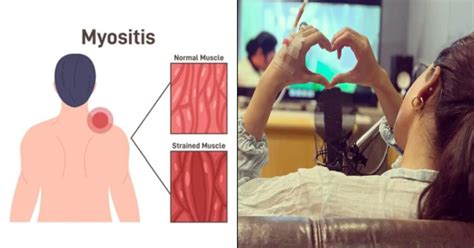 Myositis disease: All you need to know about the disease - Avaaz24