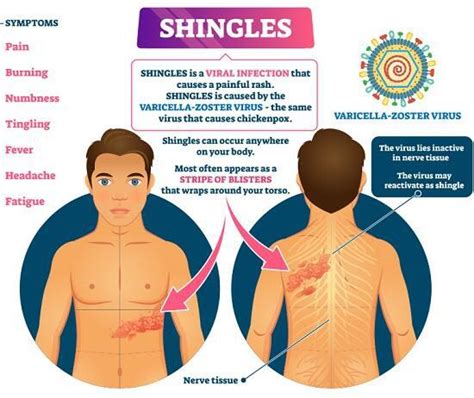 Shingles Symptoms Treatment