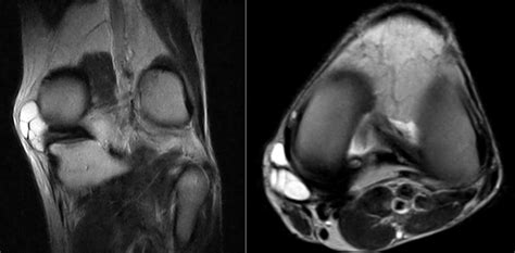 Meniscal Cyst | coachingultrasound