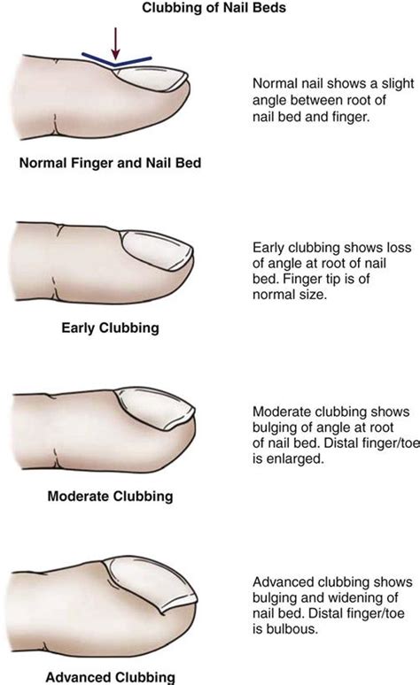 Grading Of Clubbing Of Nails - Nail Ftempo