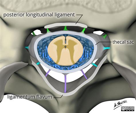 Radiopaedia - Drawing Ligamentum flavum, posterior longitudinal ...