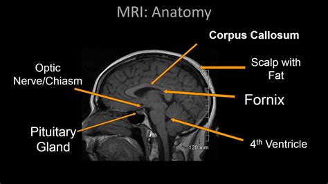 Brain Anatomy On Mri - Anatomical Charts & Posters