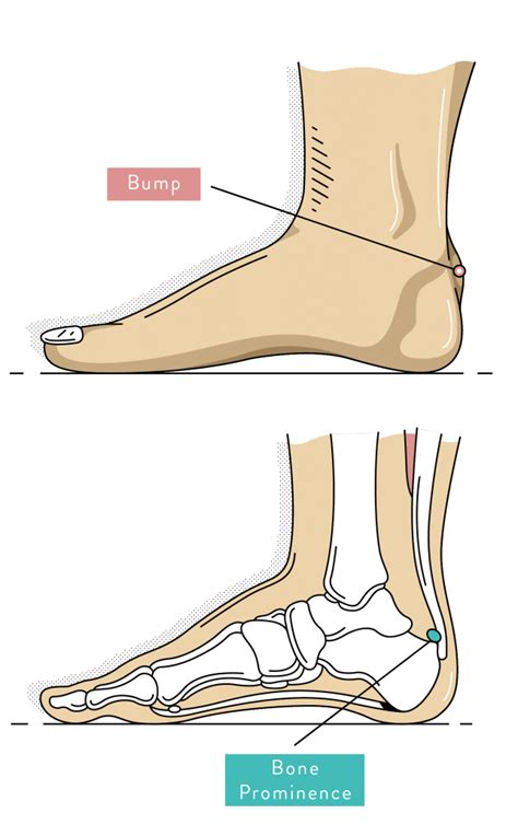 Heel Pain | Causes, Types and Podiatry Treatment