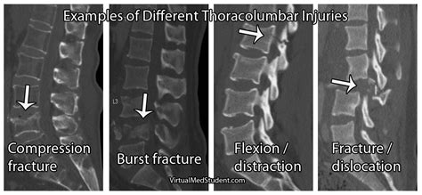 Denis’ Three Column Spine: A Simple Way to Think About Spinal Stability ...