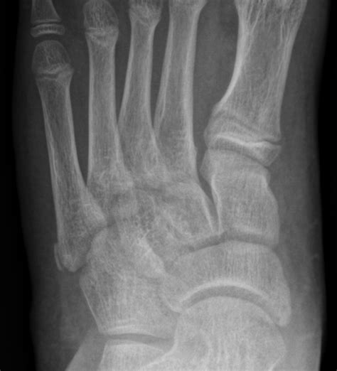 Apophysis of the proximal 5th metatarsal | Image | Radiopaedia.org