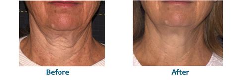 Neck Lift Without Surgery | Free Consultation