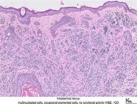 Pathology Outlines - Nevi-general