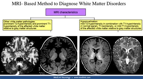 Leukodystrophies (MRI) | MedLink Neurology