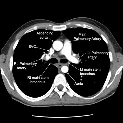 Main Pulmonary Artery