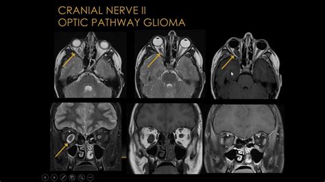 Cranial Nerve 6 Mri