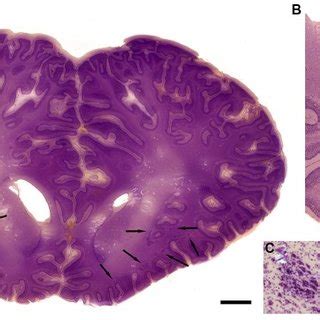 (A, B) The claustrum in the human brain. The claustrum is shown on two ...