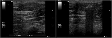 Ultrasound images of an untreated and a treated lipoma. A-An oval ...