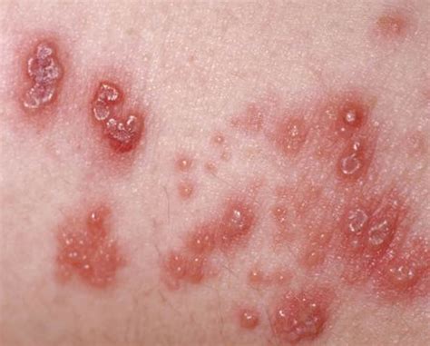 Shingles - Causes, Symptoms, Home Remedies, Treatment