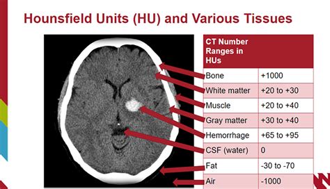 Brain Hemorrhage Scan