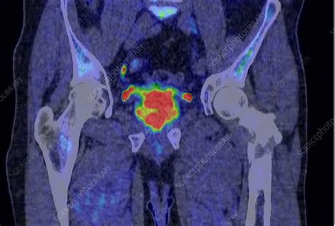 Prostate cancer, CT-PET scan - Stock Image - C048/2988 - Science Photo ...