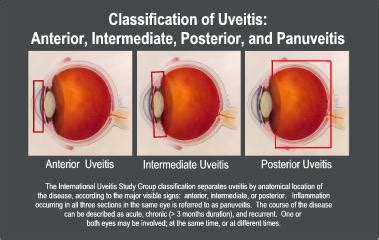 Classifymed - Uveitis.org | OIUF