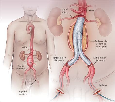 Abdominal Aortic Aneurysm Repair