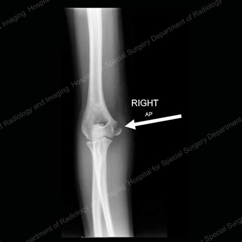 X Ray Broken Elbow