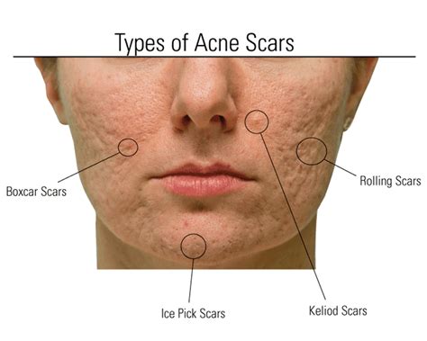 Types Of Acne Scars : Types of Acne Scars and How to Treat Them ...