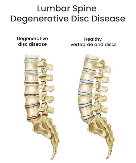 Lumbar Spine Degenerative Disc Diseases Treatment NJ & NYC