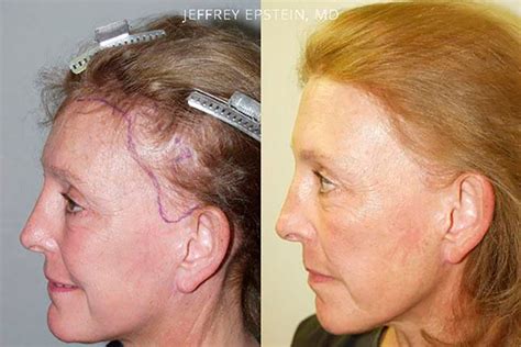 Facelift Scar Repair | Miami Repair Facelift Scarring | Hair Restoration