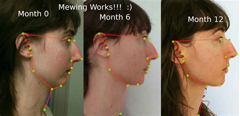 Mewing results - the proper tongue posture (mit Bildern ...