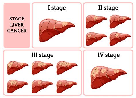 Liver Cancer Types And Stages