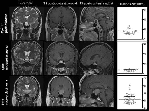 MRI Characteristics of the Prolactinoma Subgroups Characteristic ...