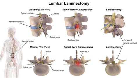 Laminectomy Surgery for Facet Joint Arthritis | Orthopedic Blog