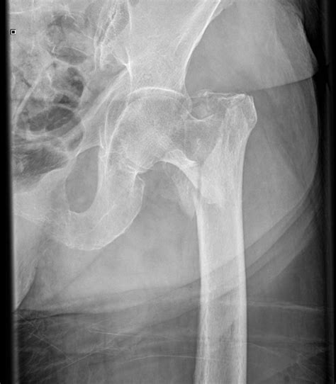 Intramedullary Nail Hip Surgery - Nail Ftempo