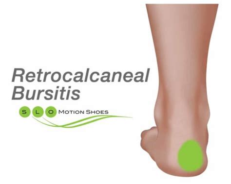 Retrocalcaneal Bursitis - SLO Motion ShoesSLO Motion Shoes