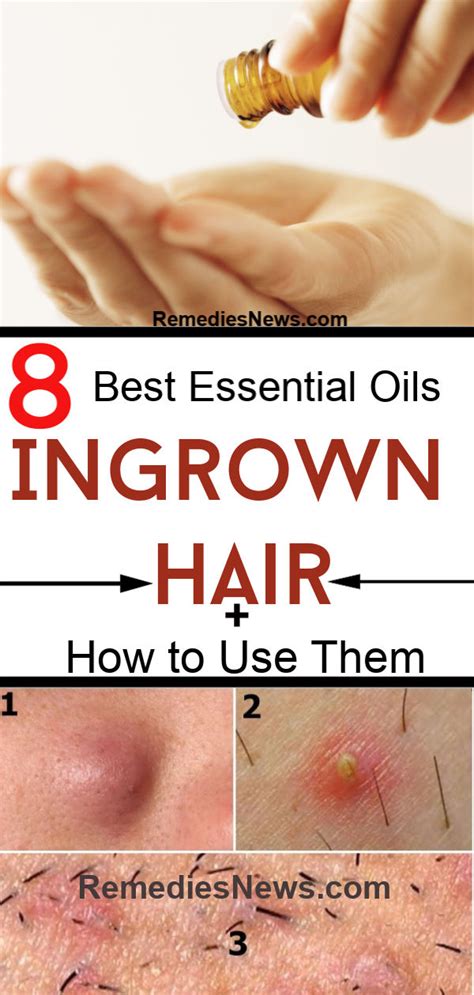 How to Use Essential Oils for Ingrown Hair: 8 Best Home Remedies