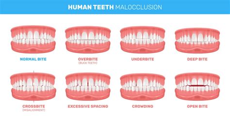 Overbite vs. Underbite: Causes, Differences & Solutions