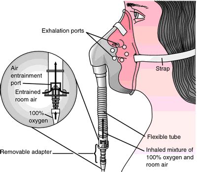 Venturi mask | definition of Venturi mask by Medical dictionary