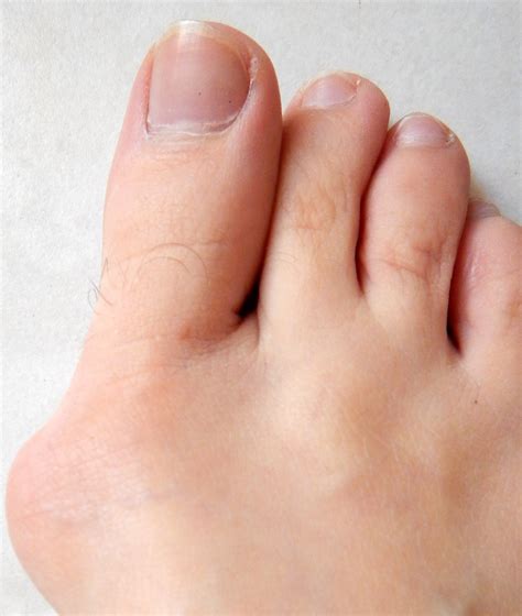 Bunion Laser Treatment: Does it work? - Vancouver Podiatry