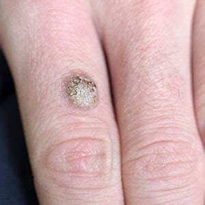 Planters Wart On Hand Removal | Bruin Blog