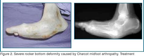 Figure 4 from Charcot Arthropathy of the Foot and Ankle | Semantic Scholar