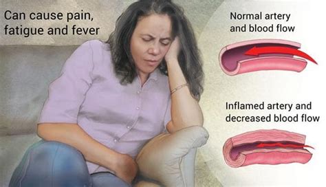 Vasculitis Symptoms