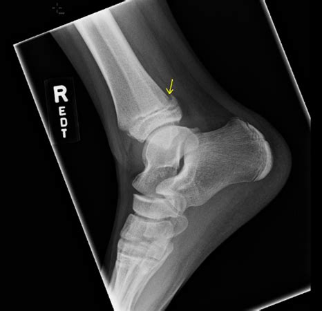 Maisonneuve Fracture Orthobullets - Ankle Fractures Trauma Orthobullets ...