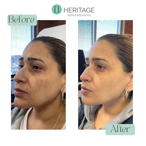 Yesenia M Radiesse® cheek filler before and after! Radiesse® is a great ...