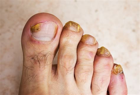 Foot Fungus Remedies – Foot Care Tips