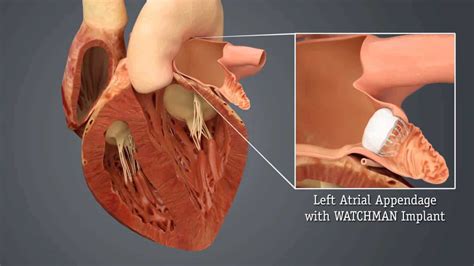 Left Atrial Appendage Occlusion (LAAO) | STROKE MANUAL