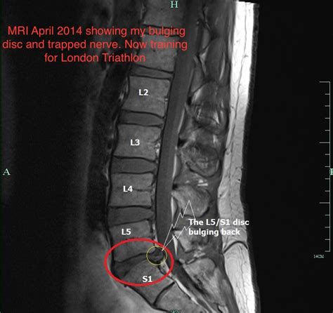 Can a physio have a slipped disc? - Boost Physio