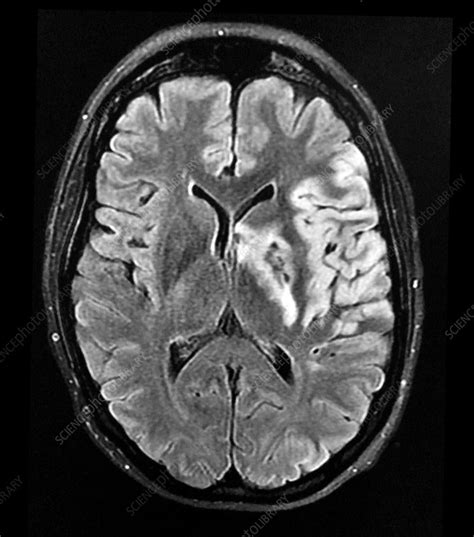 Haemorrhagic MCA Infarct MRI - Stock Image - C043/0365 - Science Photo ...