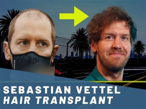 Sebastian Vettel Hair Transplant - Hair Loss & Technical Analysis