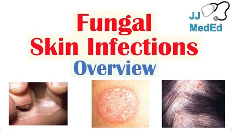 Fungal Skin Infection Hands