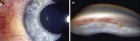 Neovascular Glaucoma | Ento Key