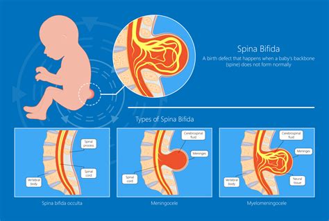 Spina Bifida | Obstetrics and Gynecology & Maternal Fetal Surgery ...