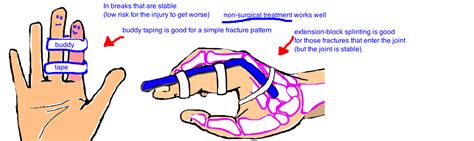 Broken Finger (phalanx fracture) — Bone Talks